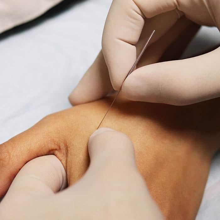 Dry Needling am Rücken bei Physio Münchenstein