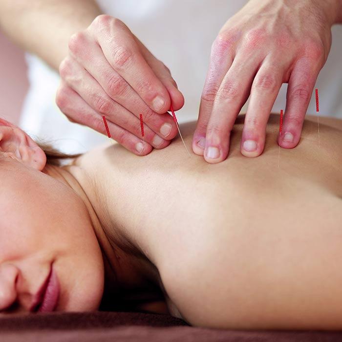 Dry Needling am Rücken bei Physio Münchenstein